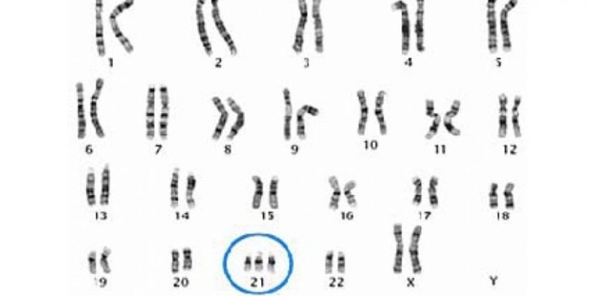 trisomie_21_chromosomes-t21